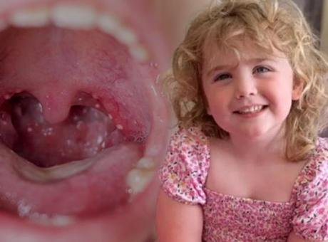 Bademcik ameliyatı 5 yaşındaki kızı hayattan kopardı! Ölümün ardındaki ‘tek gece’ detayı Betül Yasemin Kökbek / Milliyet.com.tr –İngiltere’de yaşayan 5 yaşındaki Amber