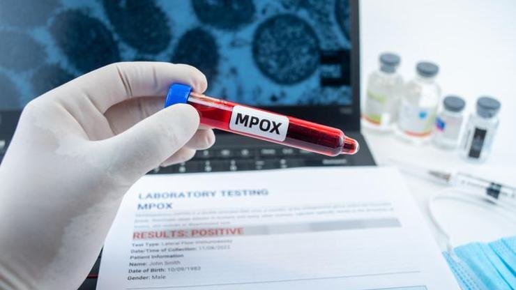 İngiltere Sağlık Güvenliği Ajansı, söz konusu varyantın farklı mpox türlerinden