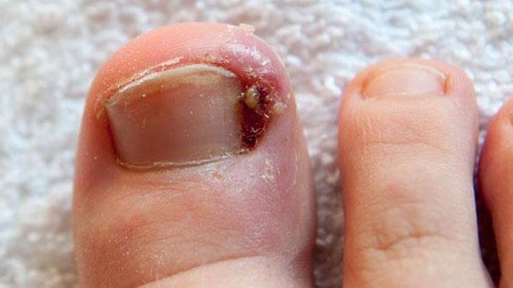 Tırnak Batması İçin Hangi Doktora Gidilir? Tırnak batmasının yaratmış olduğu