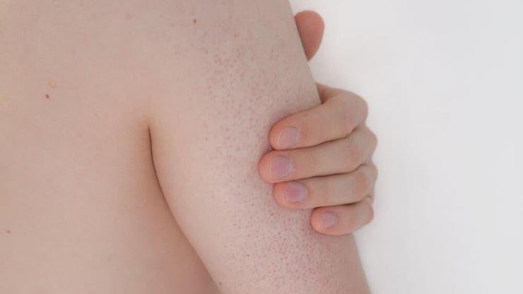 Vücutta Kırmızı Lekeler Neden Olur? Vücuttaki Kırmızı Lekeler noktalar Nasıl Geçer? Vücutta birçok kez farklı şekilde kırmızı lekeler ortaya çıkabilmektedir. Kırmızı