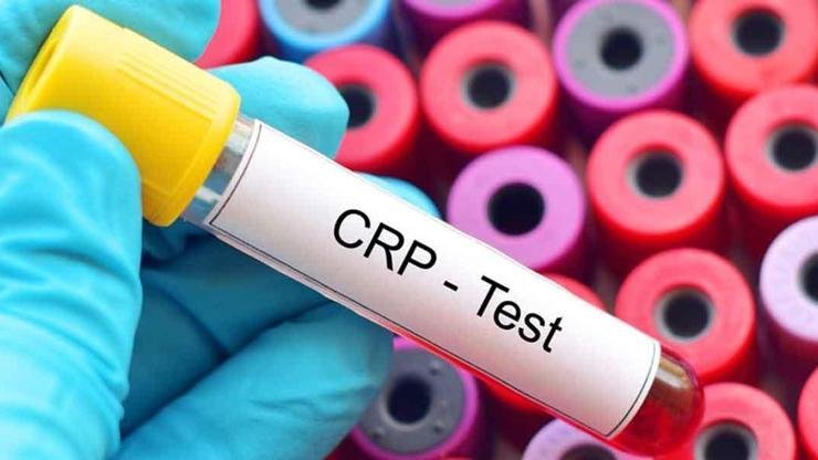 CRP Nedir? Vücudun herhangi bir yerinde iltihaplanma veya diğer rahatsızlıklar