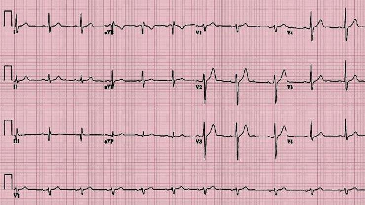 &nbsp;&nbsp;EKG Nedir? Neden Çekilir?&nbsp;&nbsp; &nbsp;EKG insan bedeninde göğüs, kol ve