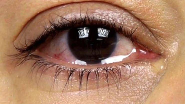 Göz Sulanması Nedir? Göz kanallarının aşırı derecede sıvı birikmesi sonucunda