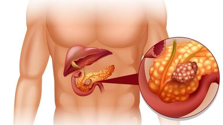 Pankreas Ağrısı Neden Olur? &nbsp;aslında pankreas, kompleks karbonhidratları ve lipitleri