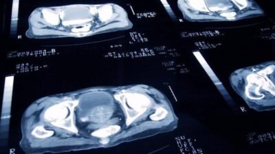 Kaynak İHA Üroloji Uzmanı Dr. İrfan Yıldırım Şentürk yaptığı açıklamada