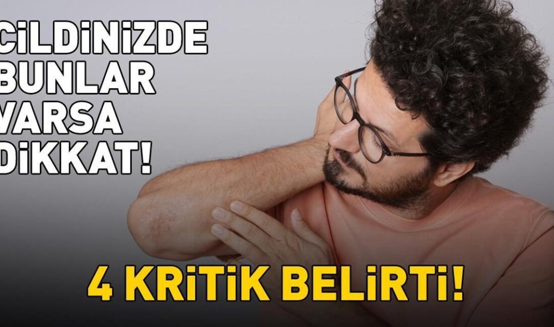 Kaynak Cnnturk.com Sedef hastalığı çoğunlukla cilt üzerinde kabarık, kalınlaşmış ve