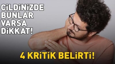 Kaynak Cnnturk.com Sedef hastalığı çoğunlukla cilt üzerinde kabarık, kalınlaşmış ve