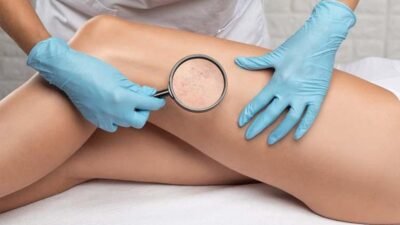 Kalp ve Damar Cerrahisi Uzmanı Prof. Dr. Haşmet Bardakçı, bacaklarda